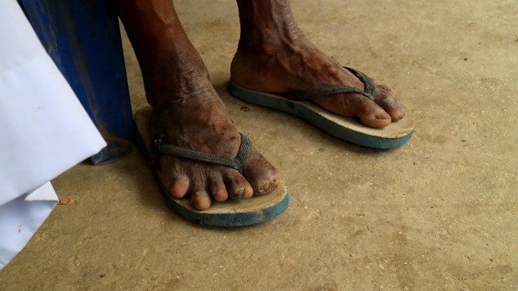 IMG_0646 No 7 Post leprosy